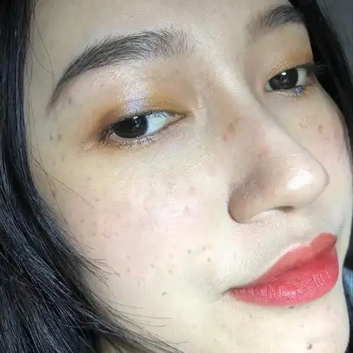 天生的雀斑怎么去除?