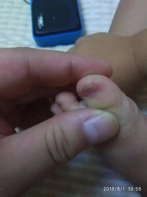 19个月宝宝指甲凹陷怎么回事儿