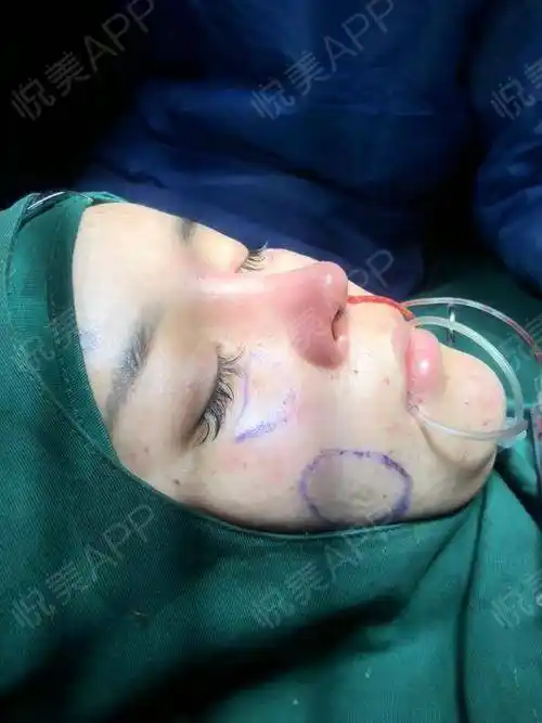 鼻子之前做过一次,但是几年前放置的但纯假体,这段时间感觉有点顶鼻头