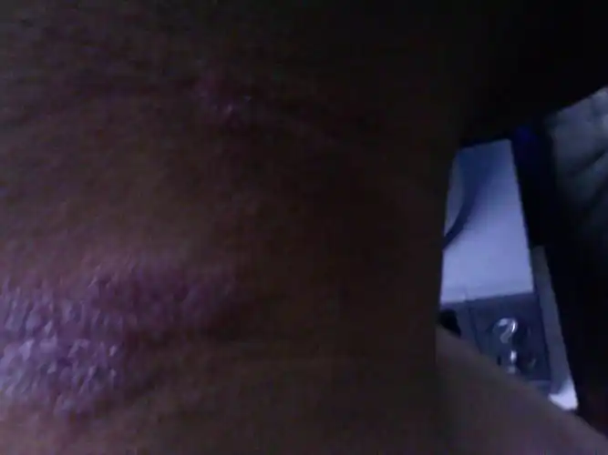 请帮我看看我脖子上是什么皮肤病.天冷没有,就天气一热就出来了