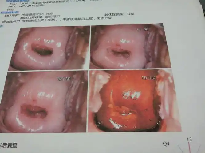 几个月前做过宫颈糜烂电灼术,今天去医院复查了,做阴道镜,医生说好了