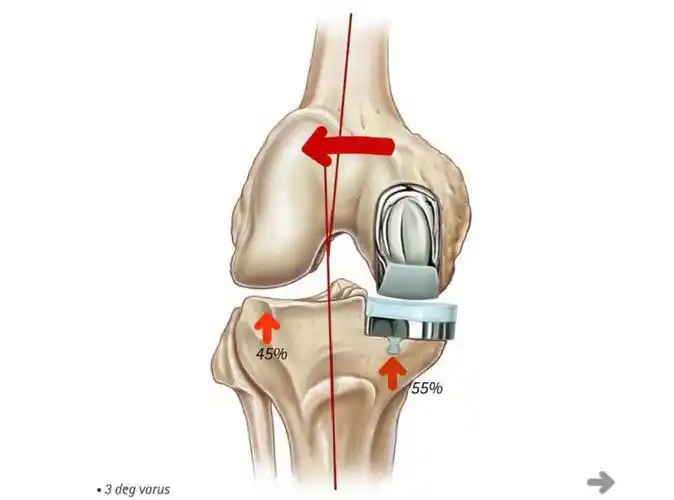 除了关节置换,膝关节炎还有哪些有效治疗方法?