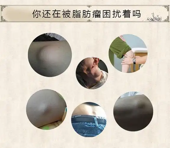 宜佰宁脂肪瘤膏去除全身消瘤膏非日本多发性去皮下囊肿膏脂肪瘤克星1