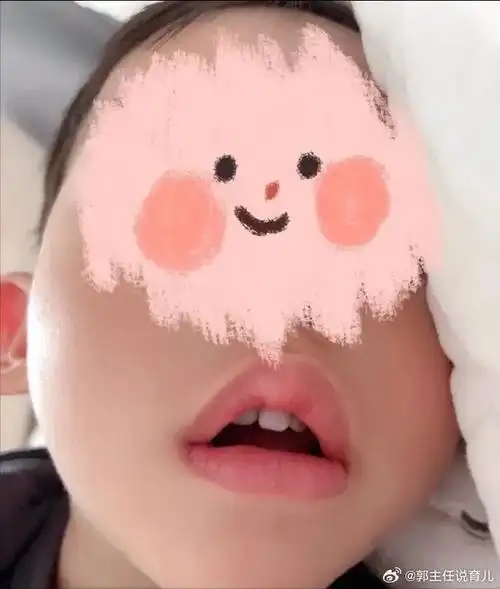 宝宝迈向腺样体面容的6个重要信号,家长一定重点关注!