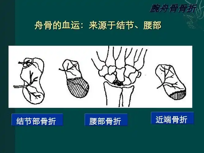 腕舟骨骨折 舟骨的血运:来源于结节,腰部 结节部骨折 腰部骨折 近端