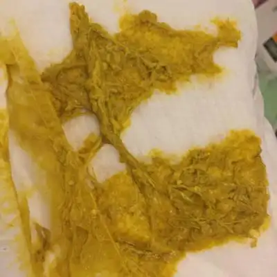 专家老师您好,孩子月子里吃母乳总是不正常,而且肚子里总是咕噜咕噜的