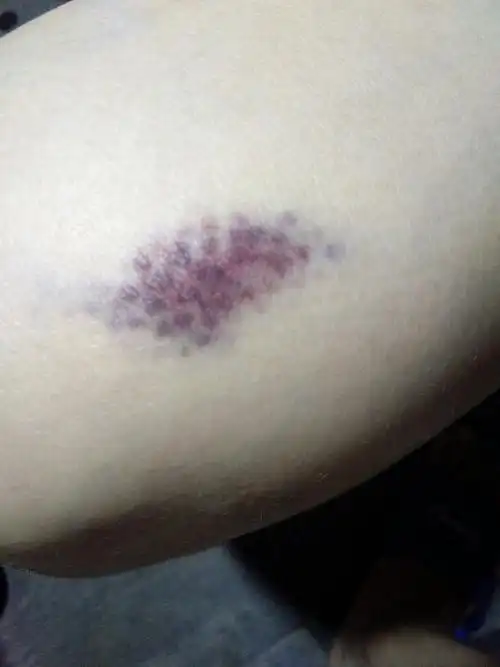 老婆怀孕7个月不小心撞到木门,腿部出现淤青怎么处理?