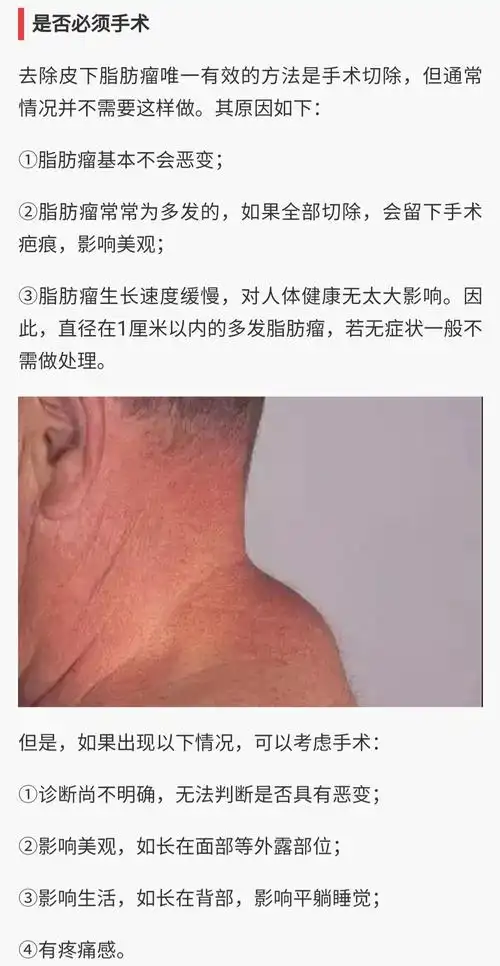 脂肪瘤_介绍_检查_治疗方式 - 好大夫在线