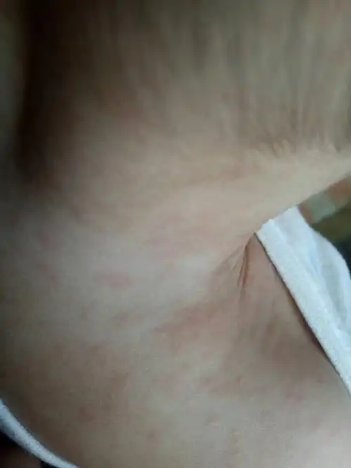 幼儿常见问题之幼儿急疹