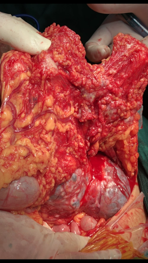 胰腺囊腺癌的胰体尾部切除 - 好大夫在线