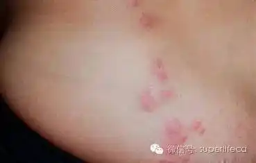 床虱最近又开始肆虐了 防床虱攻略
