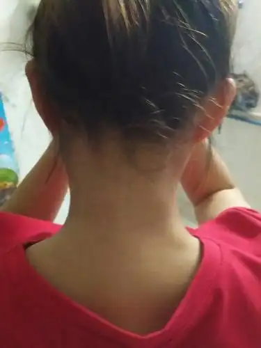 脖子后面长了两坨肉肉,左边一个,右边一个,是不是刮痧引起的呢