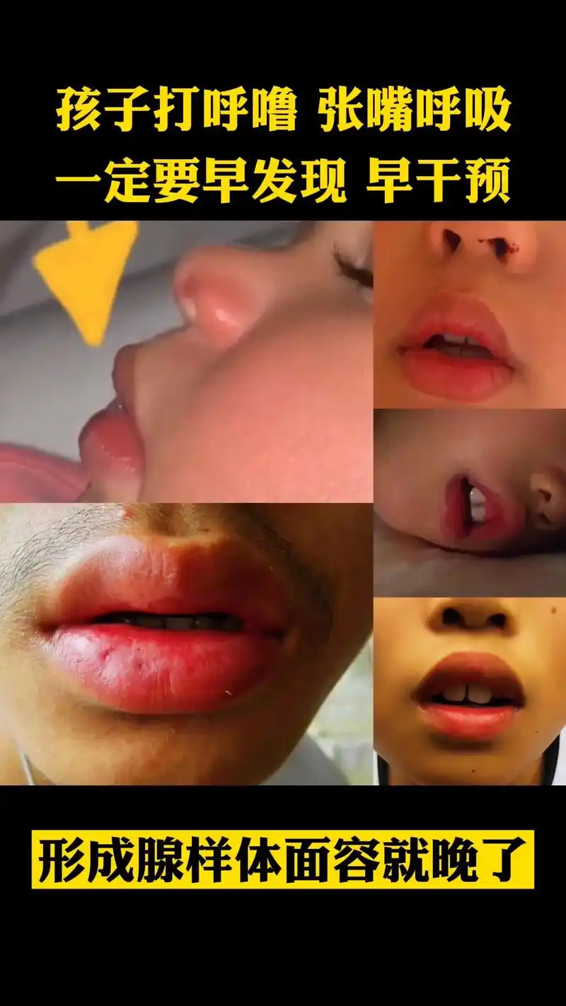 腺样体肥大 #腺样体面容 #医学科普 #耳鼻喉臧洪瑞 - 抖音