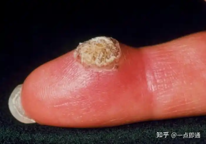 但是实际上,hpv病毒的感染并不分男女,只不过男性的免疫力相对好一些