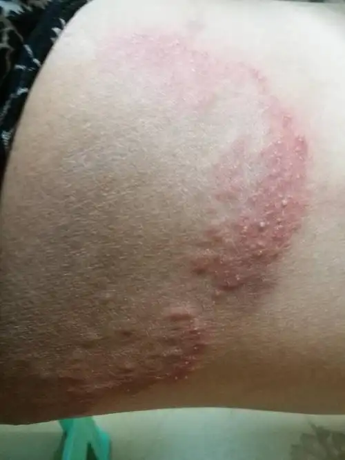 在腹股沟位置,以前好像有股藓,有点痒,一直也没去治疗过!