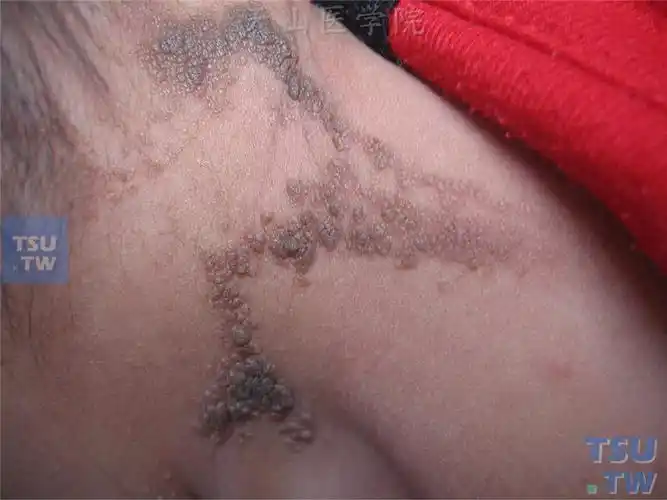 颈后棕褐色疣状增生,排列呈带状,表面呈颗粒状乳头瘤样