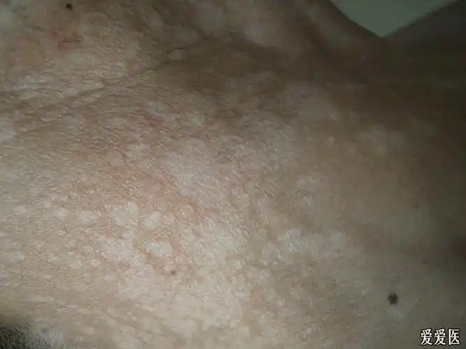 典型病例欣赏花斑癣