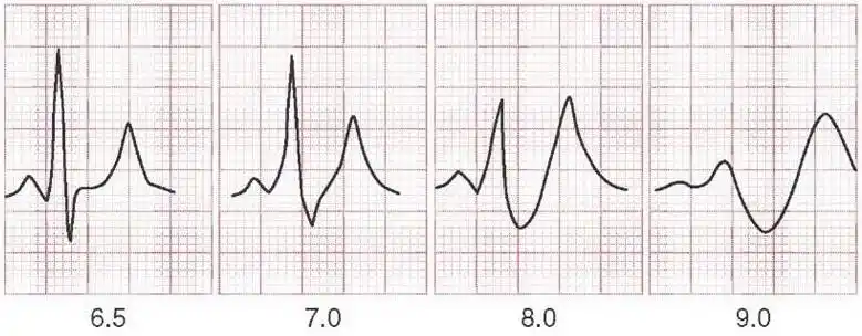 高钾血症首先出现的心电图改变是t波高耸,qt间期缩短,随着血钾浓度