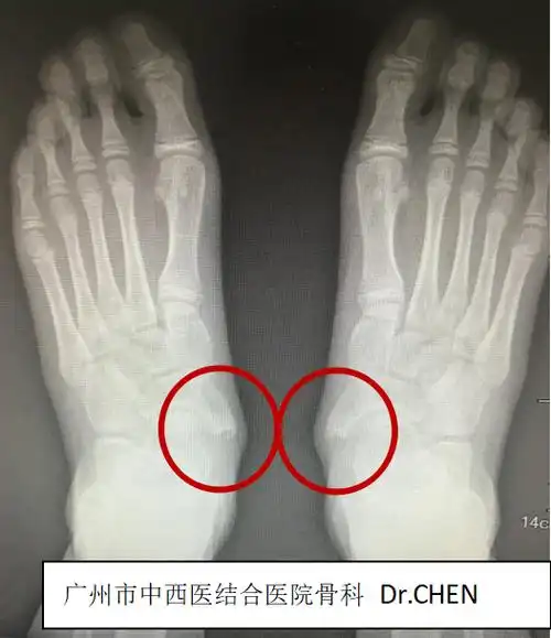 足痛隆起畸形当心副舟骨疼痛综合征在作怪