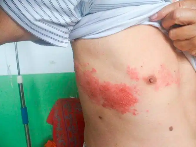 带状疱疹的临床症状有哪些?会传染吗?