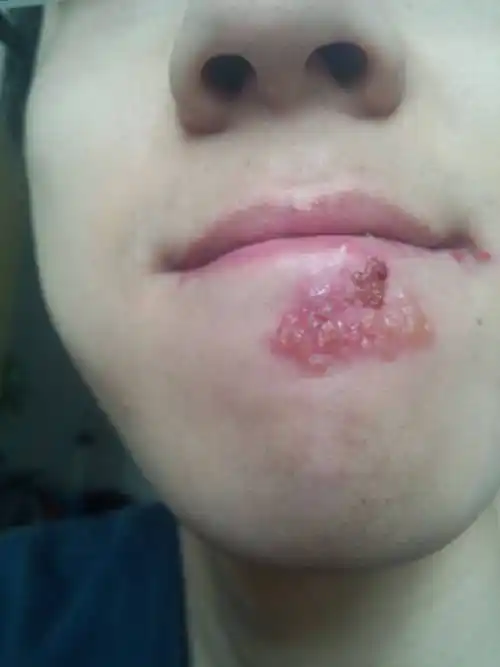 发烧时嘴角长水泡是怎么回事?跟带状疱疹是一回事吗?_病毒_身体_水痘