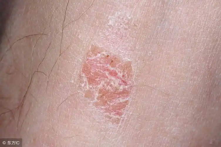 性病医院临床上的男性生殖器疱疹是指疱疹病毒,是群中等小的双股dna