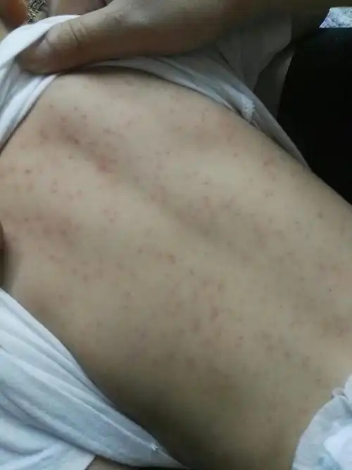 宝宝19日凌晨0点10几分突然发烧39度,给他喂了退烧药,到早上6点多又