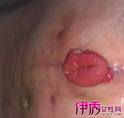 【图】为你造口手术的原理和相关经禁忌 保证让你有备无患