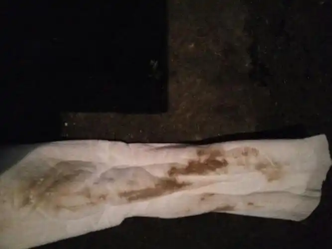 3妇科炎症可能诱发月经有黑色血块月经有黑色血块,也有可能是血性白带