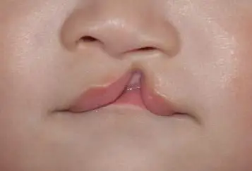 什么是唇裂?先天性兔唇能完全修复吗?__凤凰网