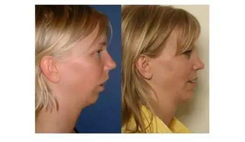 26岁的腺样体面容怎么治疗,等你围观!