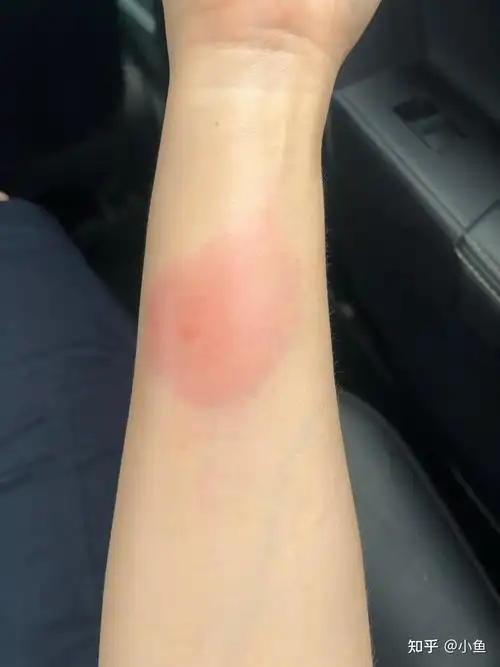 被蚊子咬的包第二天都肿的特别大怎办