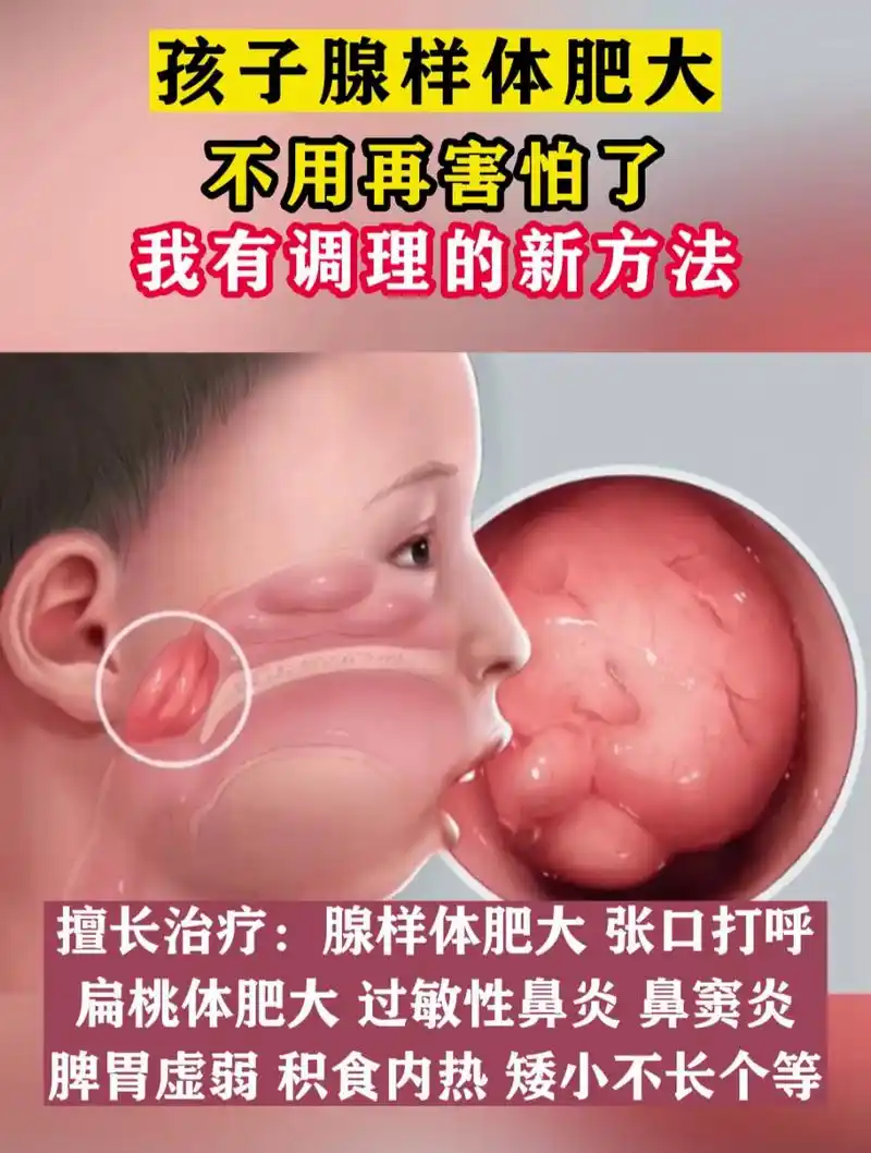 分享一个治疗腺样体肥大的临床验方,这个方子对于小儿过敏性鼻炎同样