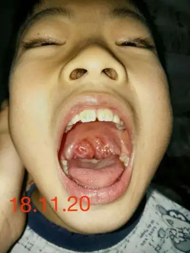 伙伴扁桃体肿大调理,父母们,别动不动就给孩子切除扁桃体,那可是人体
