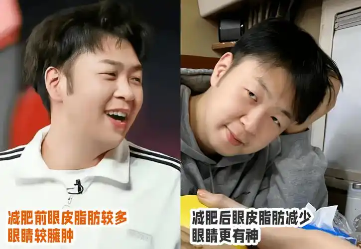比如杜海涛,减肥前和减肥后,眼睛的差别不要太大其实,眼皮脂肪太多也