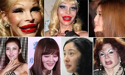 世界各地网红整容失败案例