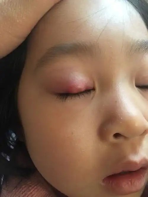 霰粒肿全麻手术值得不值得?