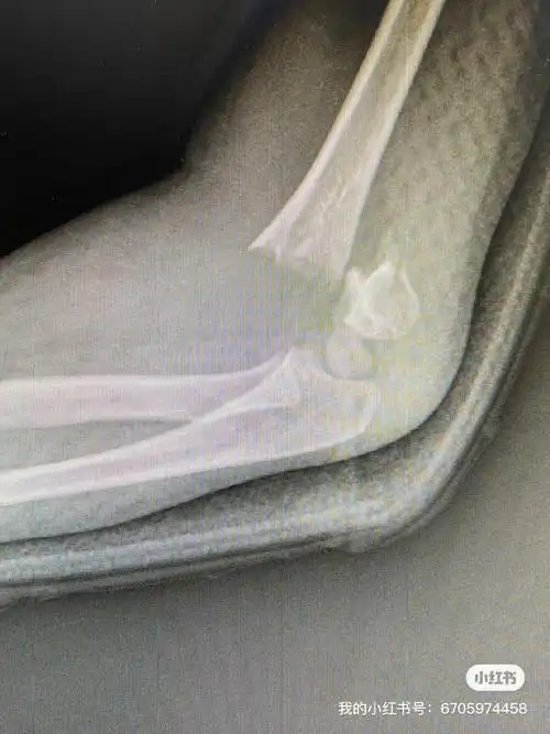 91孩子在受伤后,只是简单进行保守治疗,拆除石膏后才发现手肘长歪了