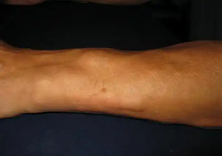 脂肪瘤是什么,得了脂肪瘤该怎么办?