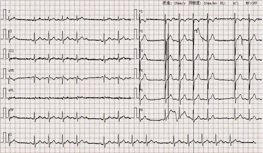 心电图图库丨二度i型房室传导阻滞系列