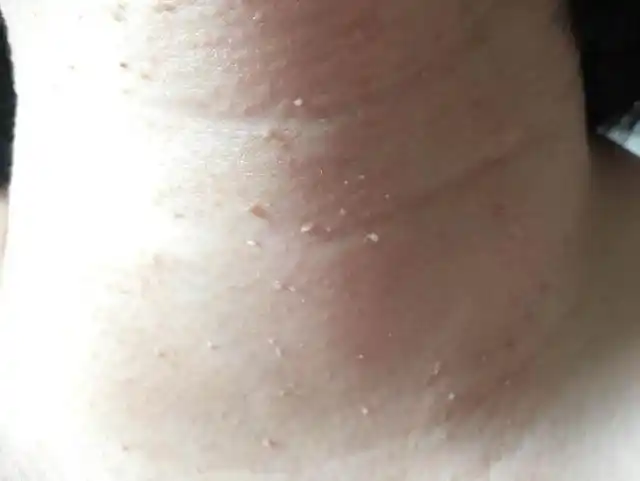 脖子,腋下等处长的"小肉粒",到底是什么?要不要处理?