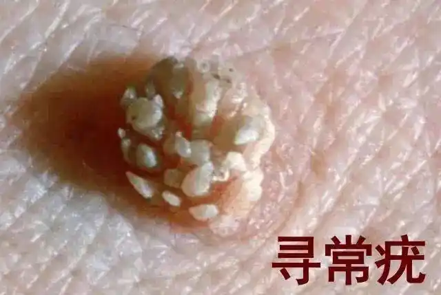 比如明显的生殖器疣以及不明显的宫颈,阴道,外阴,尿道,阴茎,肛门疣等