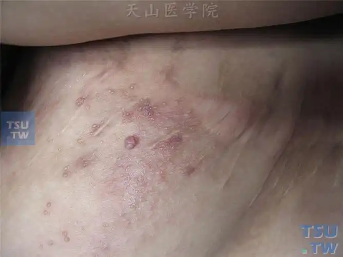 【附图】 良性肿瘤:淋巴管瘤(lymphangioma)症状表现 _皮肤病诊断图谱