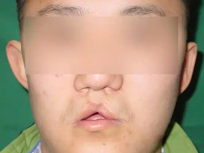 继发唇裂整形修复 - 好大夫在线