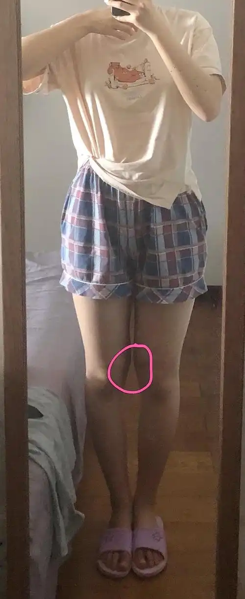 姐妹们 膝盖内侧这块可以减吗