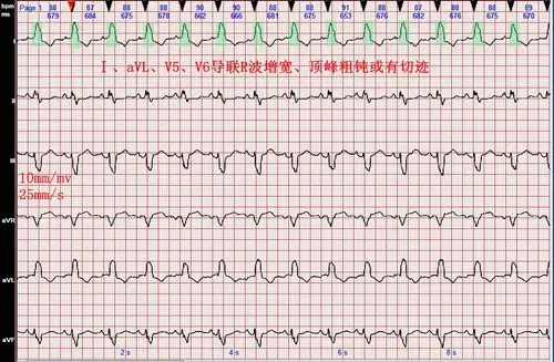心电图病例分析完全性左束支阻滞