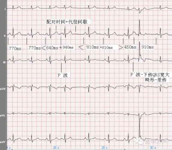 心电图课堂|第8期:房性早搏