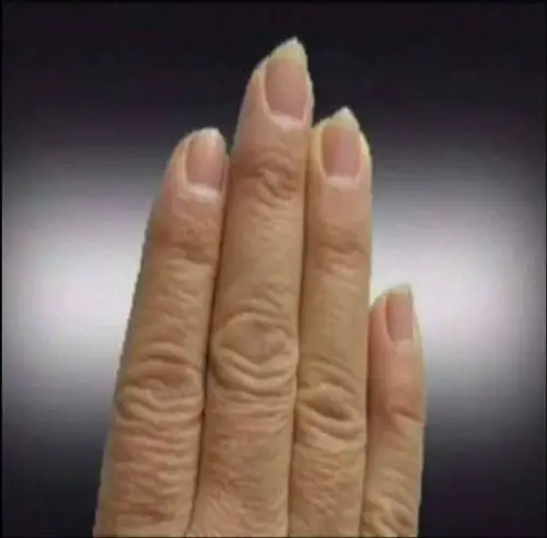 双手8～10个手指要有半月痕.