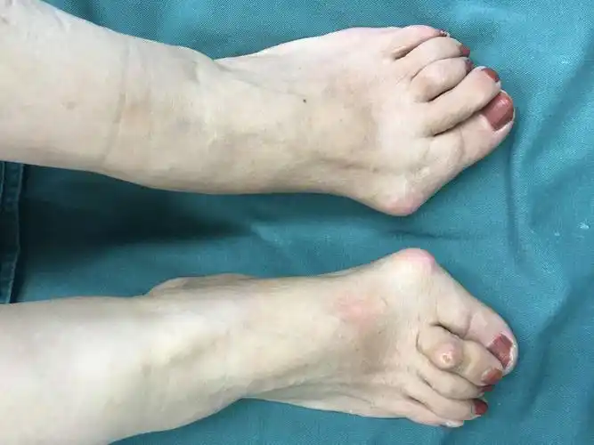 双足重度拇外翻