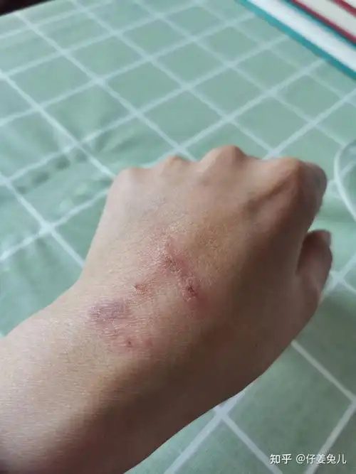 暖水袋烫伤恢复日记